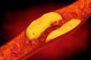 Atherosclerosis is the narrowing of the arteries due to a build-up of fatty deposits